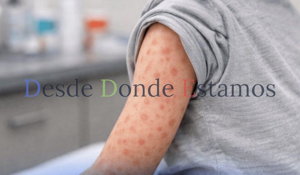 Analizan seis casos sospechosos de sarampión